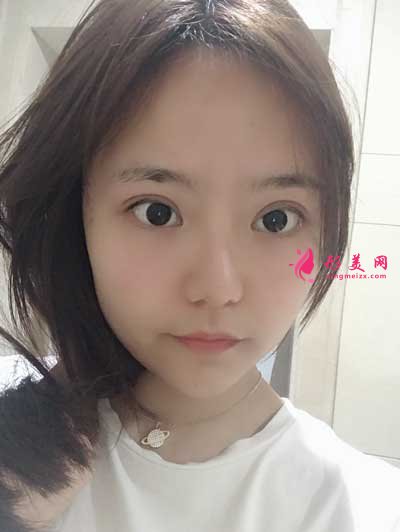 淚干無(wú)息的切開(kāi)雙眼皮術(shù)后51天照