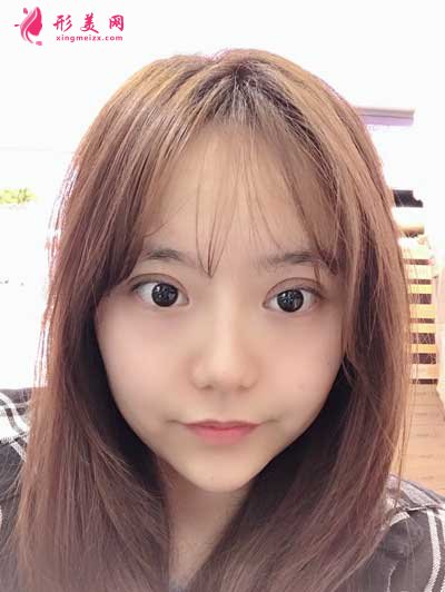 淚干無(wú)息的切開(kāi)雙眼皮術(shù)后28天照