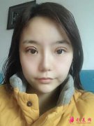 成都素美天資李曹鵬做的切開雙眼皮，效果真是太好了