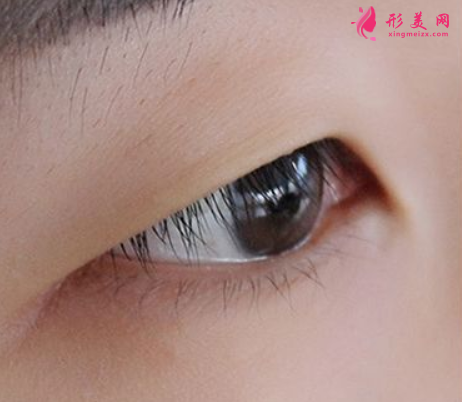 內(nèi)雙并且上眼皮脂肪厚怎么辦