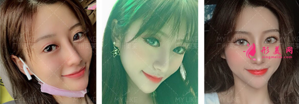 美萊達(dá)拉斯隆鼻.png