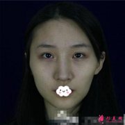 磨顴骨前后對比圖~磨骨手術(shù)能給你帶來的效果須知！