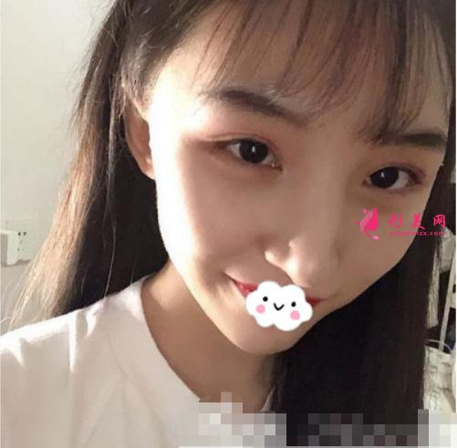 磨顴骨手術術后半個月
