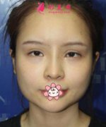 下頜角磨骨整形術(shù)是怎樣做的？想知道手術(shù)步驟！真人案例分享
