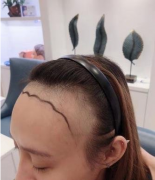 廣西武警總隊(duì)醫(yī)院植發(fā)怎么樣？發(fā)際線移植前后對比效果圖