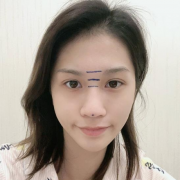 上海百達麗王艷隆鼻怎么樣？隆鼻術后效果，網友親身經歷講述~