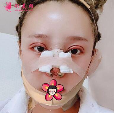 削骨手術(shù)對比圖變化也太大了吧！不信你看！