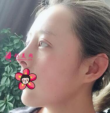 削骨手術(shù)對比圖變化也太大了吧！不信你看！