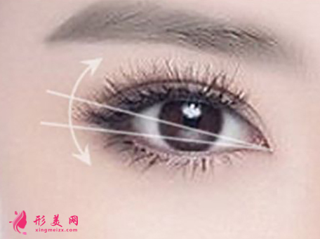 開(kāi)眼角手術(shù)后可以戴眼鏡嗎