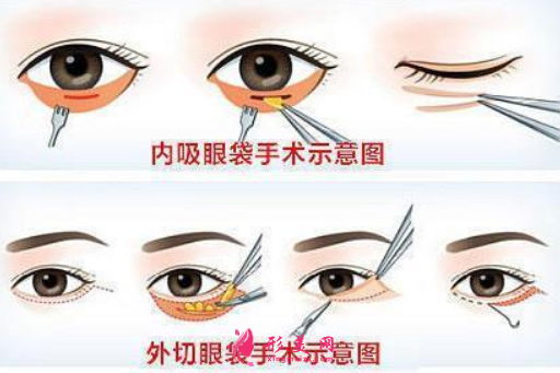 做手術(shù)祛眼袋術(shù)前要做什么準(zhǔn)備