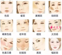 激光祛斑的恢復(fù)期長(zhǎng)不長(zhǎng)呢?