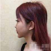 廣州曙光醫(yī)學美容醫(yī)院價格表及肋軟骨隆鼻案例分享