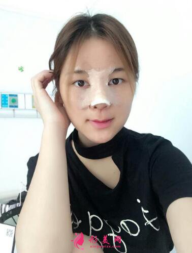 西寧時光整形醫(yī)院隆鼻
