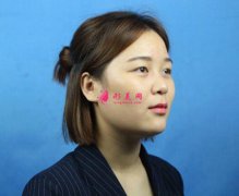西寧時光整形醫(yī)院隆鼻案例，五官都立體了~