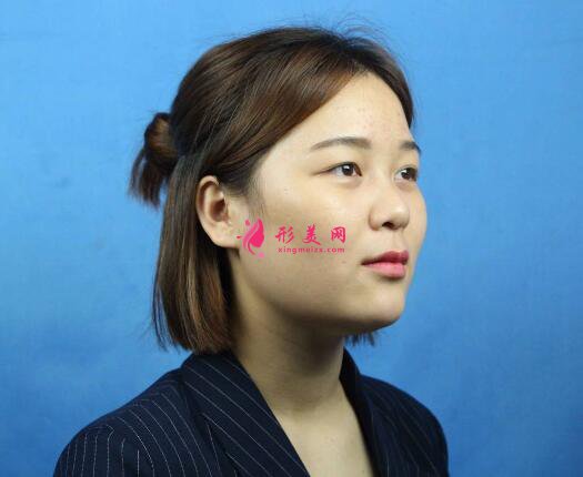 西寧時光整形醫(yī)院隆鼻