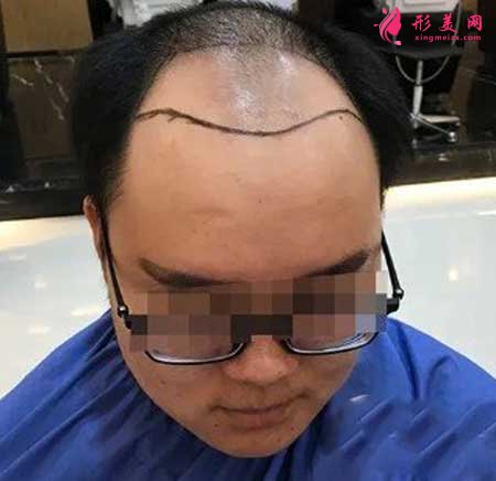 成都雍禾醫(yī)院禿頂4600單位植發(fā)案例