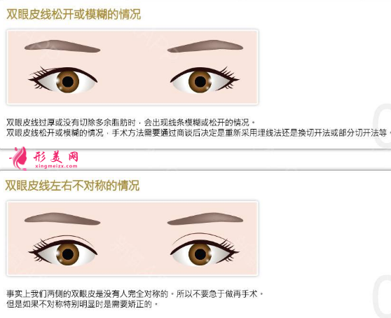 雙眼皮手術怎么修復