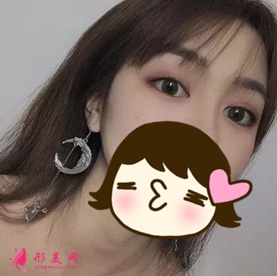 俞翰秀醫(yī)生技術(shù)怎么樣？雙眼皮案例