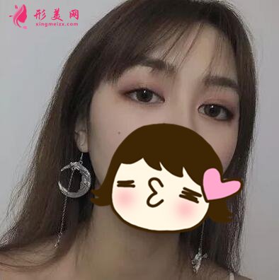 俞翰秀醫(yī)生技術(shù)怎么樣？雙眼皮案例