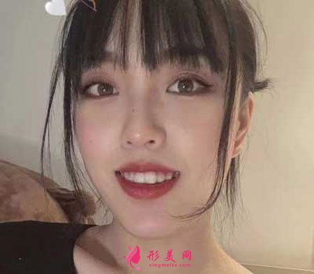 在鄭州天后整形做的隱形矯正，術(shù)后效果特別好！