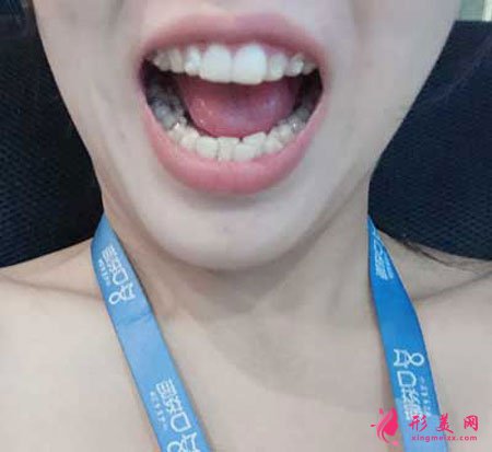 在鄭州天后整形做的隱形矯正，術(shù)后效果特別好！