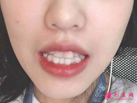 在鄭州天后整形做的隱形矯正，術(shù)后效果特別好！