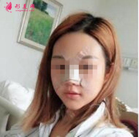 鄭州麗天整形自體軟骨墊鼻尖怎么樣？小翹鼻好好看！