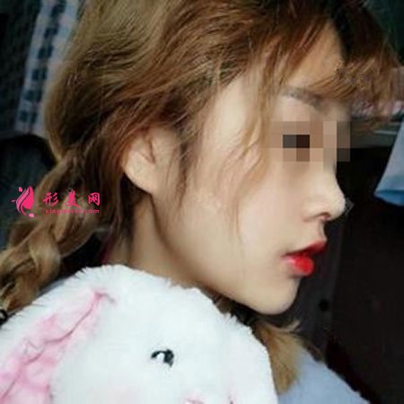 鄭州麗天整形自體軟骨墊鼻尖怎么樣？小翹鼻好好看！