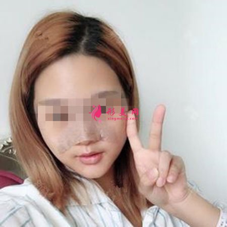 鄭州麗天整形自體軟骨墊鼻尖怎么樣？小翹鼻好好看！