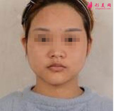 鄭州麗天整形自體軟骨墊鼻尖怎么樣？小翹鼻好好看！
