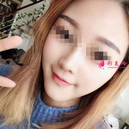 鄭州麗天整形自體軟骨墊鼻尖怎么樣？小翹鼻好好看！