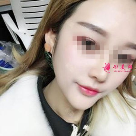 鄭州麗天整形自體軟骨墊鼻尖怎么樣？小翹鼻好好看！