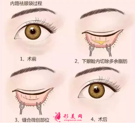 手術(shù)切除眼袋的效果能保持多久