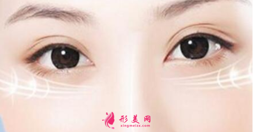 手術(shù)切除眼袋的效果能保持多久