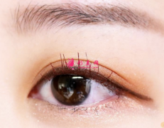 開(kāi)眼角手術(shù)后多久可以戴隱形眼鏡?
