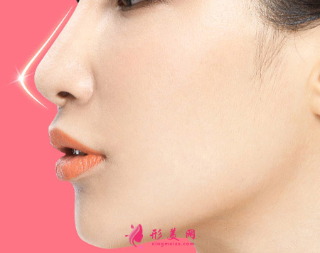 假體隆鼻的效果多久穩(wěn)定下來