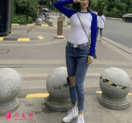 西京醫(yī)院整形外科的吸脂瘦大腿案例