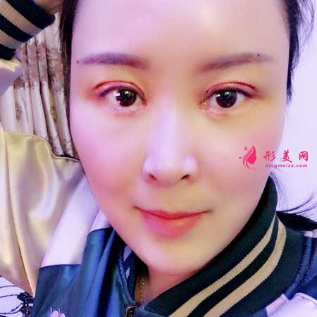 重慶華美整形醫(yī)院的雙眼皮成功案例