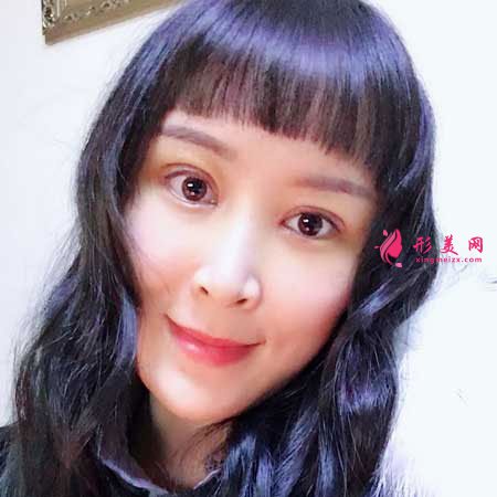 重慶華美整形醫(yī)院的雙眼皮成功案例