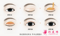 韓式雙眼皮手術(shù)效果怎么樣？?jī)?yōu)點(diǎn)有哪些？