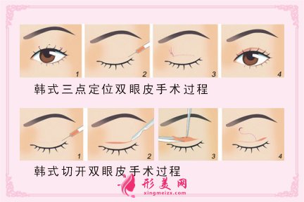 韓式雙眼皮手術(shù)效果