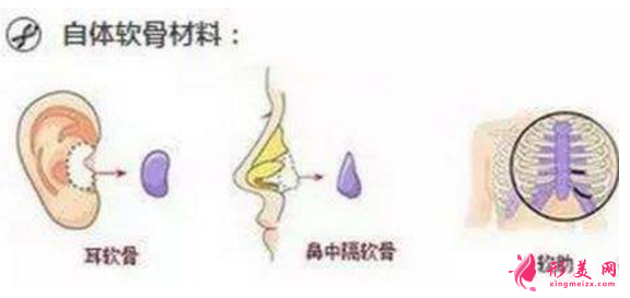自體軟骨隆鼻價(jià)格