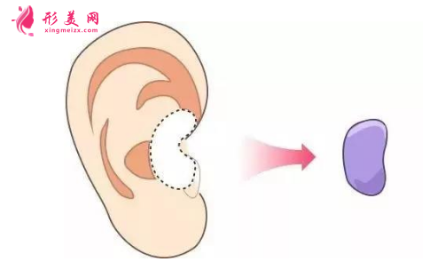 自體軟骨隆鼻價(jià)格