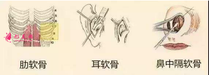 自體軟骨隆鼻價(jià)格