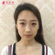 成都軍大鐘正強(qiáng)給我做的線雕隆鼻，鼻子特別好看特別精致