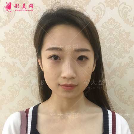 線雕隆鼻術(shù)后第一天