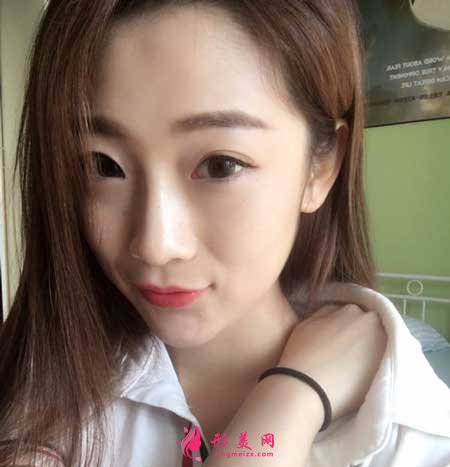線雕隆鼻術(shù)后70天