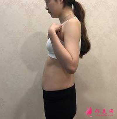 在鄭州悅美整形美容醫(yī)院做吸脂瘦腰腹+瘦大腿手術(shù)前