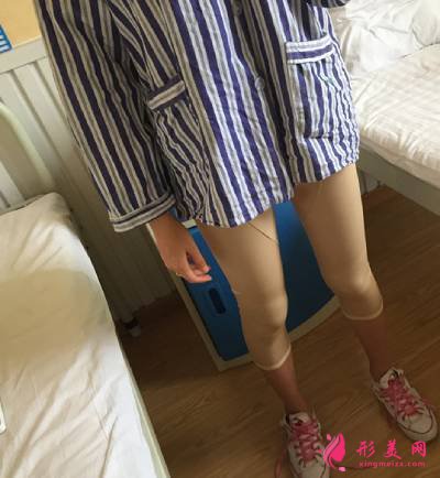 在鄭州悅美整形美容醫(yī)院做的吸脂瘦大腿手術(shù)后4天