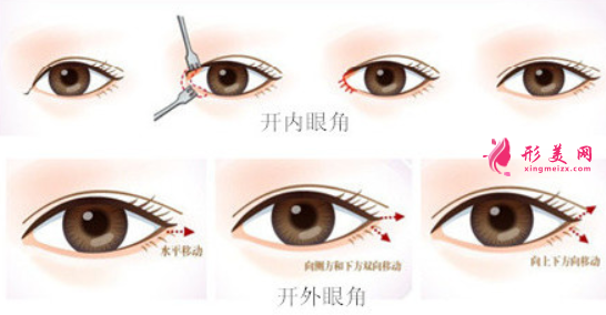 做開眼角手術(shù)恢復(fù)期有什么需要注意的